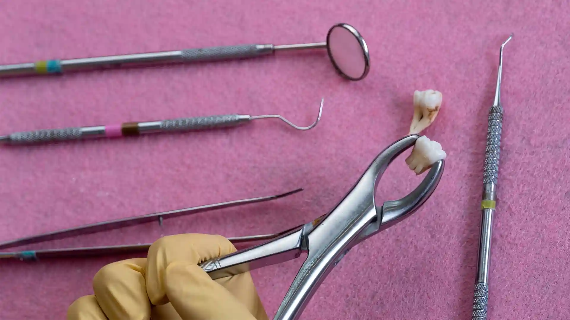 tooth extraction